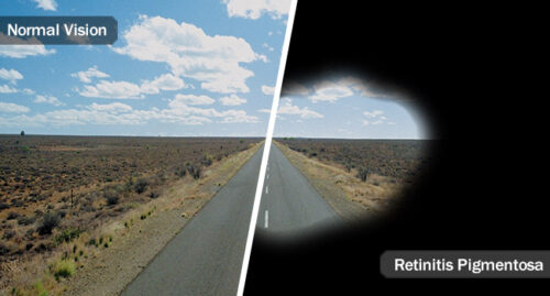 normal vision vs ush vision, ush syndrome